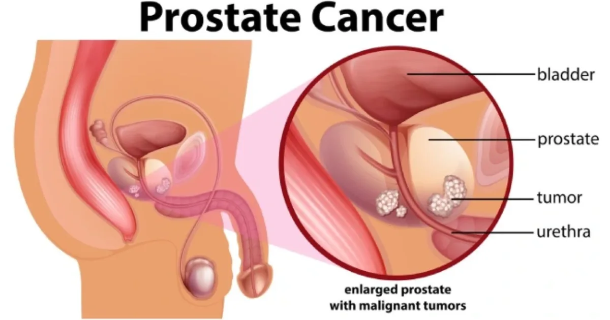 What Is the Longest Someone Has Lived With Stage 4 Prostate Cancer